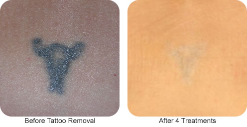 Before and after tattoo removal in Houston